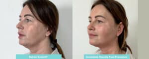 endolift non surgical facelift essex london jowls treatment neck lift before and after