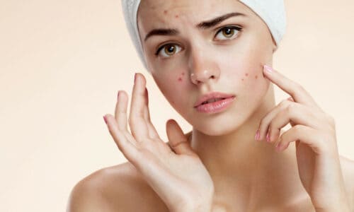 Acne Anxiety: What Is The Best Treatment?