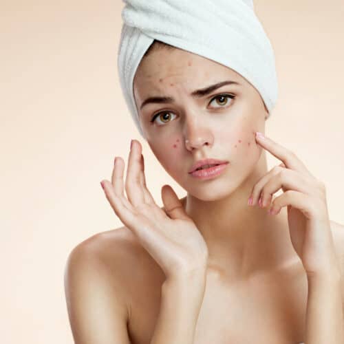 Acne Anxiety: What Is The Best Treatment?