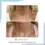 results neck