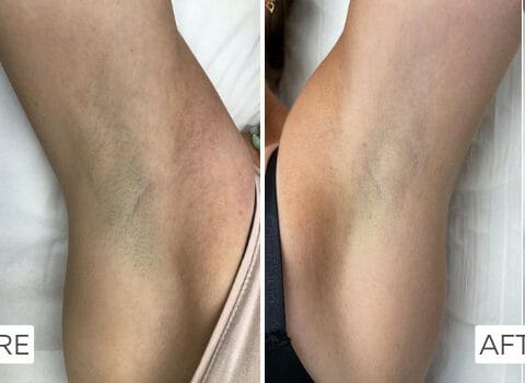 Laser Hair Removal Results