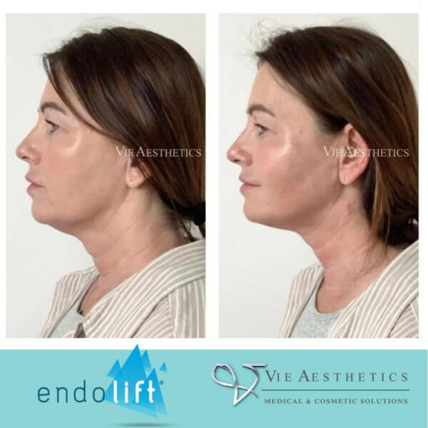 endolift rayleigh essex facelift ageing sagging skin