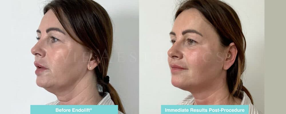 endolift non surgical facelift essex jowls treatment neck lift before and after jowl lift without surgery