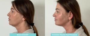 endolift non surgical facelift essex jowls treatment neck lift before and after