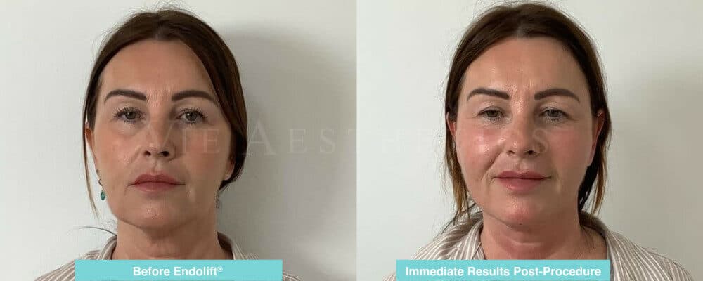 endolift non surgical facelift essex jowls treatment neck lift before and after