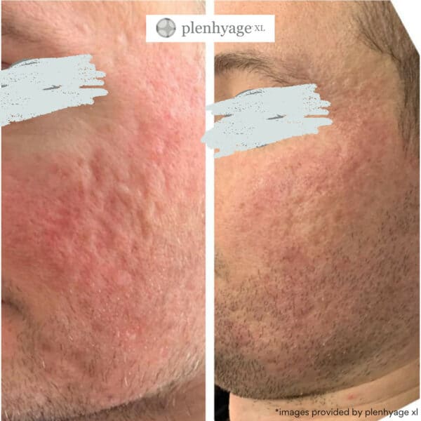 plenhyage xl acne scarring harley street london