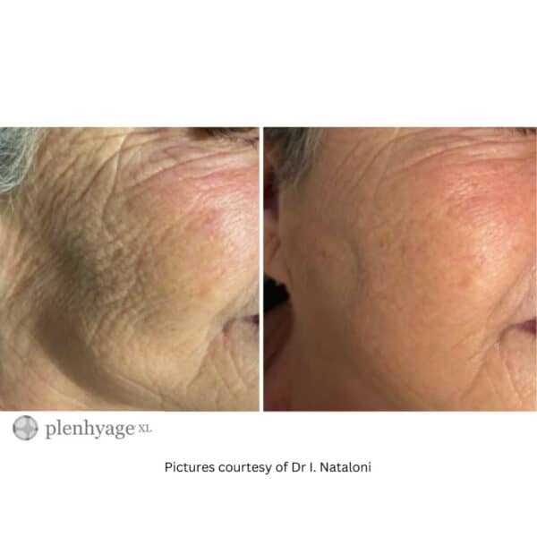 plenhyage xl ageing skin treatment rayleigh essex