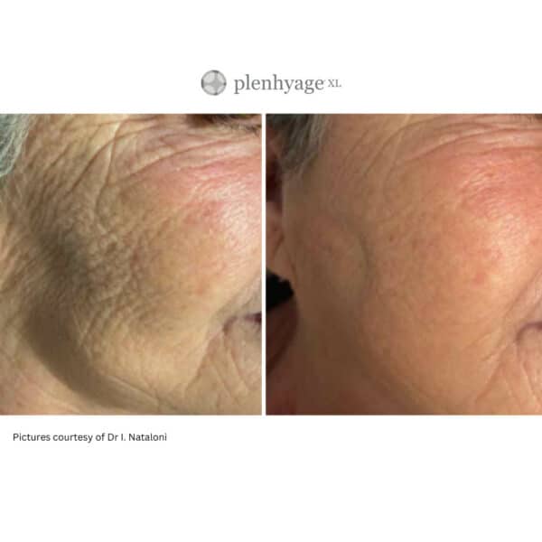 plenhyage xl ageing skin treatment harley street london