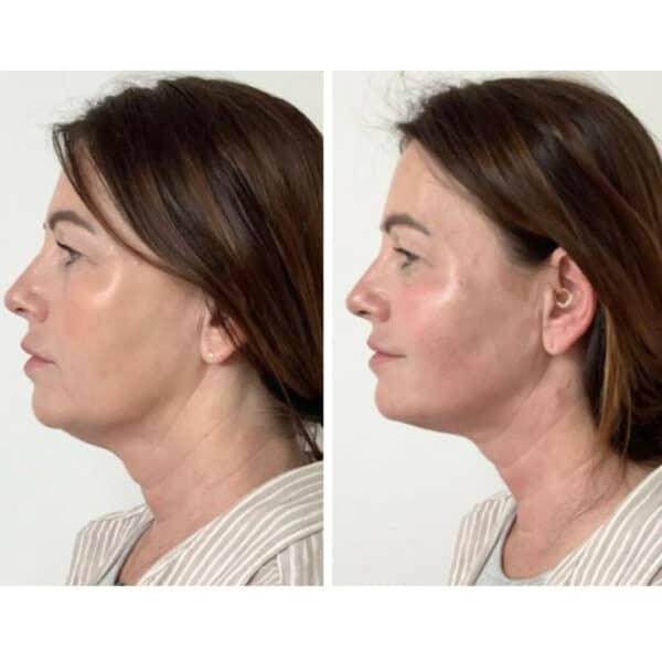 endolift in harley street london before and after image vie aesthetics