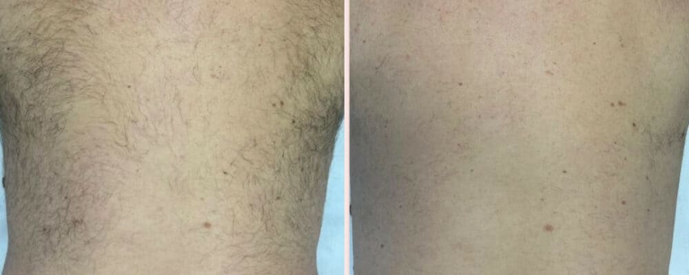 laser hair removal back diolaze essex london harley street holborn near me