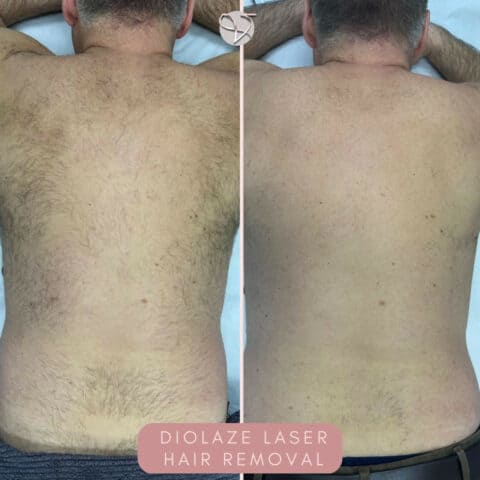 laser hair removal back diolaze essex london harley street holborn near me