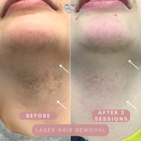 laser hair removal rayleigh essex london