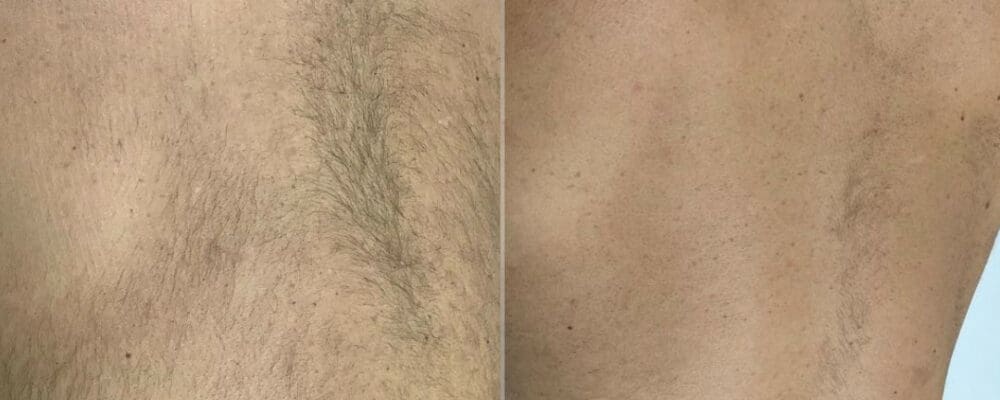 laser hair removal rayleigh essex london