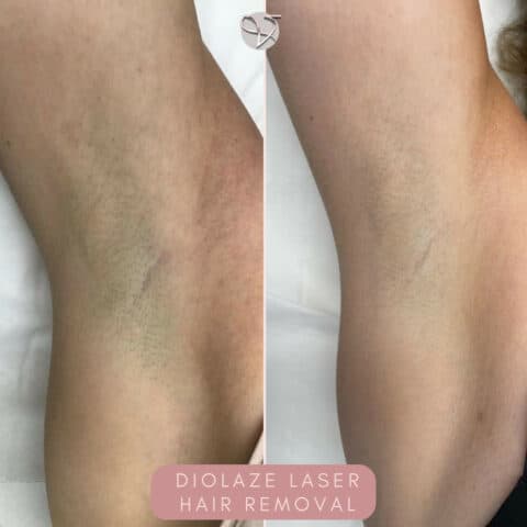 laser hair removal rayleigh essex london