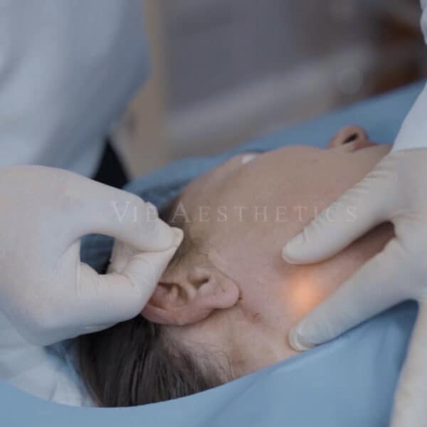 endolift essex rayleigh non surgical facelift laser