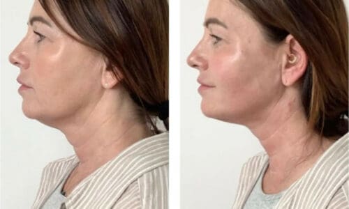 Endolift Before and After