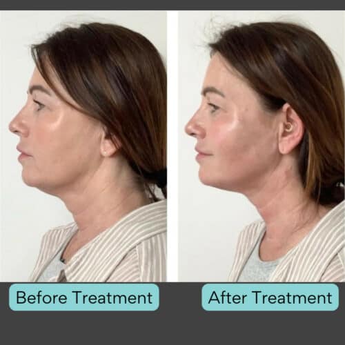 Endolift Before and After