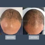 hair loss treatment hair transplant regenera activa