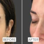 morpheus8 eyes results before and after skin tightening anti wrinkle treatment rayleigh essex holborn
