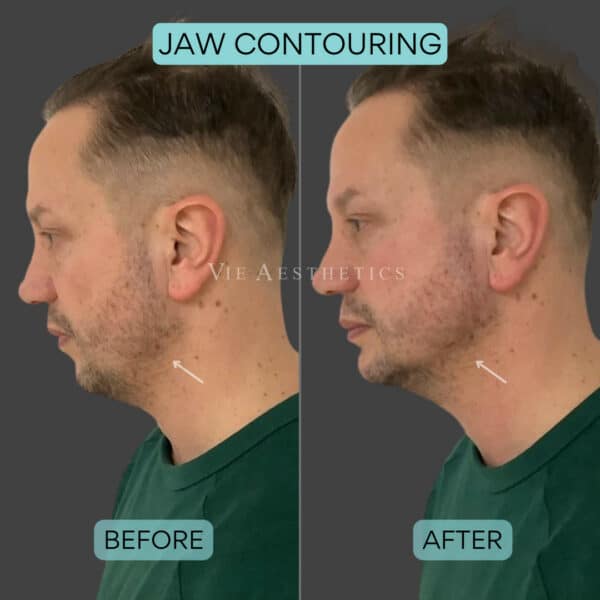 male facial contouring jaw filler holborn vie aesthetics chris wild dr liakas