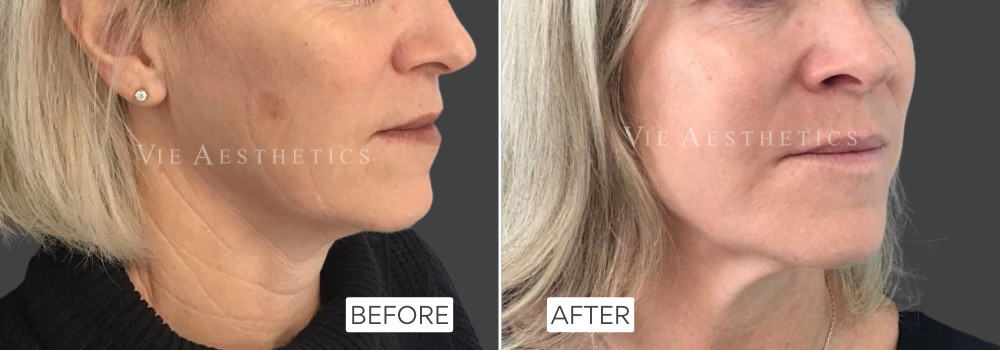 morpheus8 full face lower face neck results before and after skin tightening anti wrinkle treatment rayleigh essex holborn