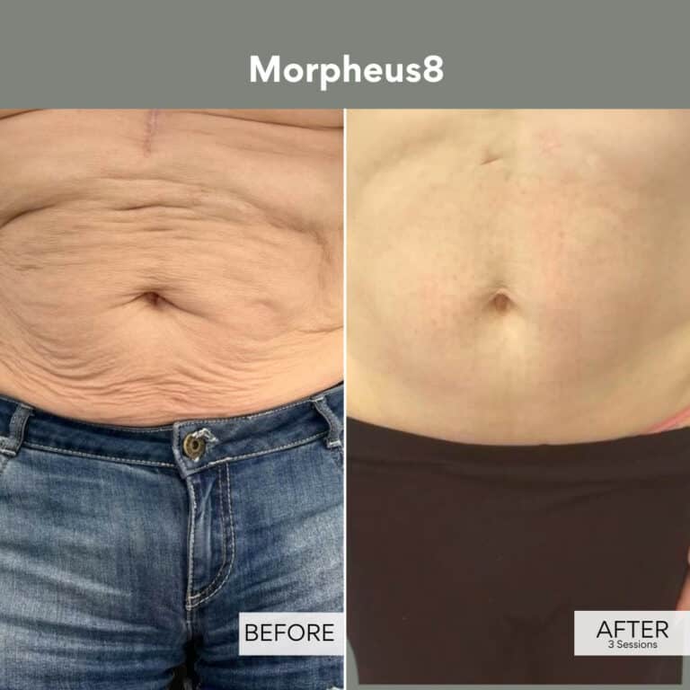 best tightening treatment blog morpheus8 results vie aesthetics