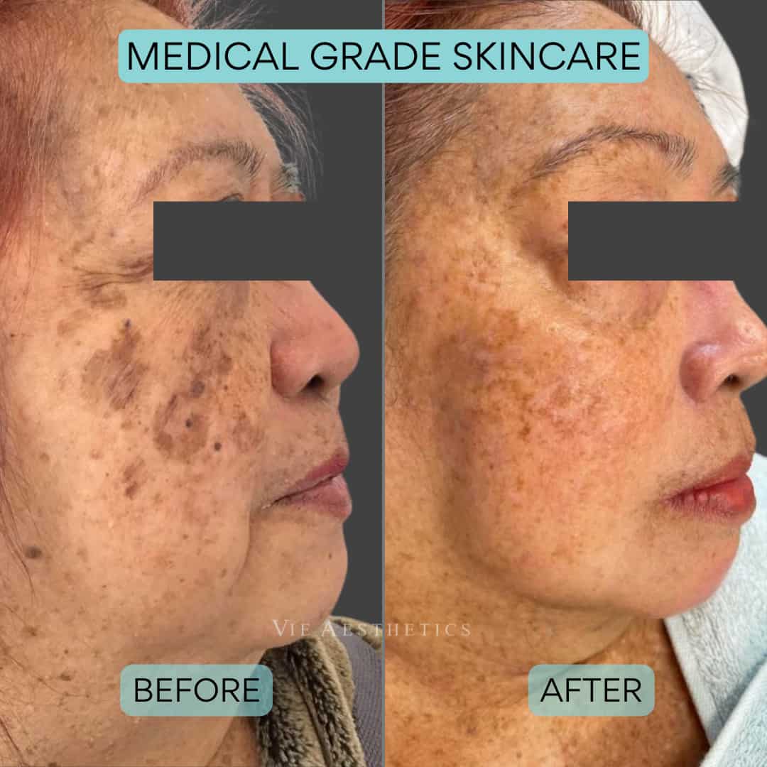 hyperpigmentation medical grade skincare before and after results london holborn rayleigh essex vie aesthetics