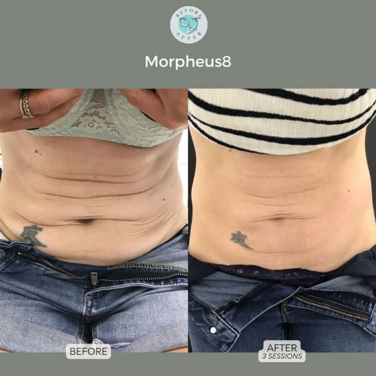 best tightening treatment blog morpheus8 results vie aesthetics