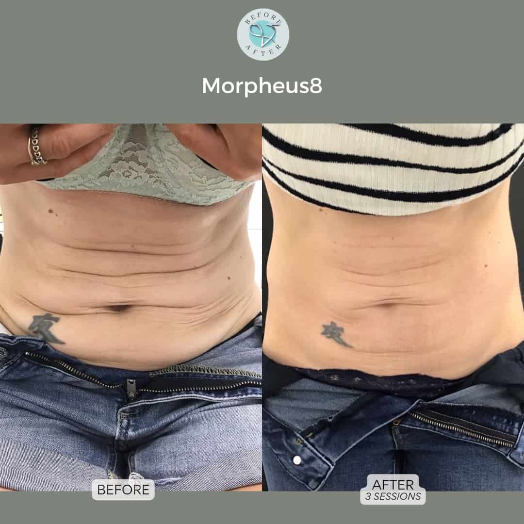 best tightening treatment blog morpheus8 results vie aesthetics