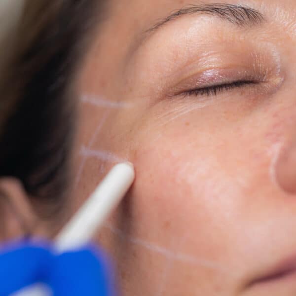 endolift in holborn london image 2 vie aesthetics