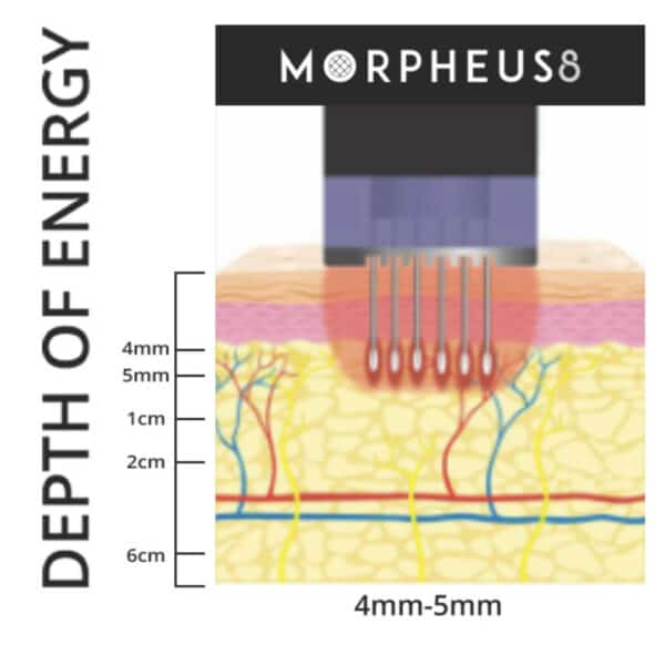 morpheus8 skin remodelling in london vie aesthetics image device