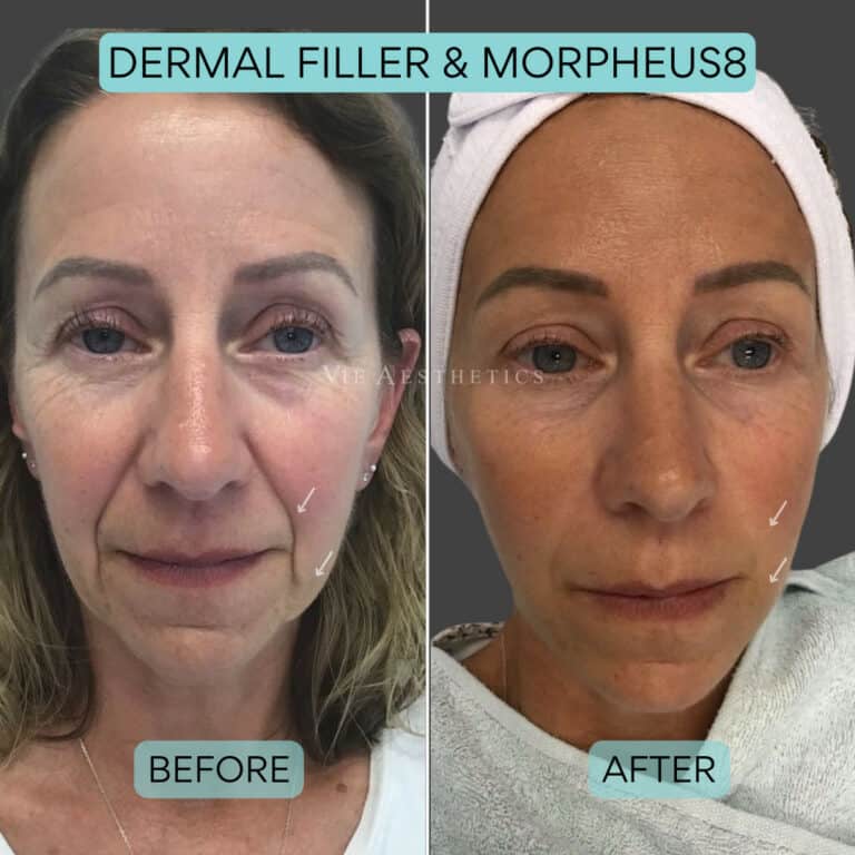 morpheus8 essex and london before and after vie aesthetics