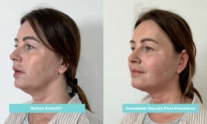 endolift non surgical facelift essex jowls treatment neck lift before and after