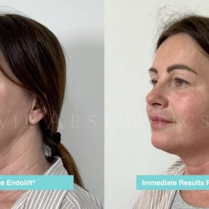 Endolift Before and After