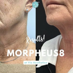 Morpheus8 Before & Afters | Morpheus8 Results