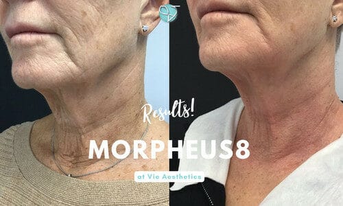 Morpheus8 Before & Afters | Morpheus8 Results