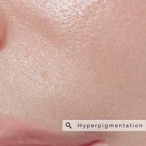 Hyperpigmentation Types, Causes & Treatments