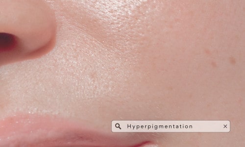 Hyperpigmentation Types, Causes & Treatments