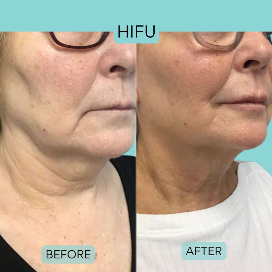 hifu skin tightening before and after results image 2 vie aesthetics