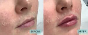 lip filler before and after london