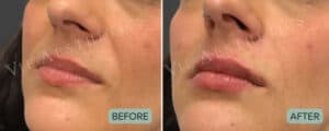lip filler before and after london