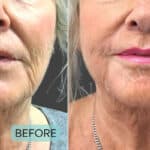 thread lift before and after silhouette soft pdo threads