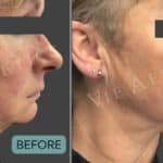 thread lift before and after silhouette soft pdo threads