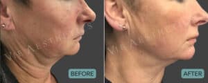 thread lift before and after pdo elionce jowls sagging skin neck vie aesthetics essex rayleigh