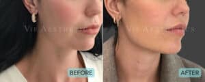 elionce pdo thread lift london holborn jaw line jaw lift jowls sagging skin jawline definition 