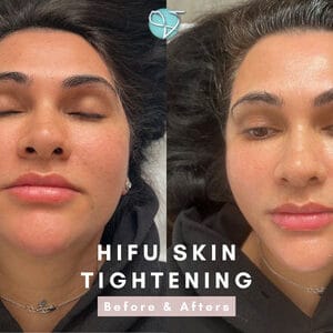 HIFU Before & After | Results