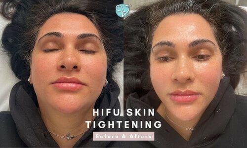 HIFU Before & After | Results