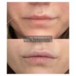 BOCA One-Thread-Lip-Lift
