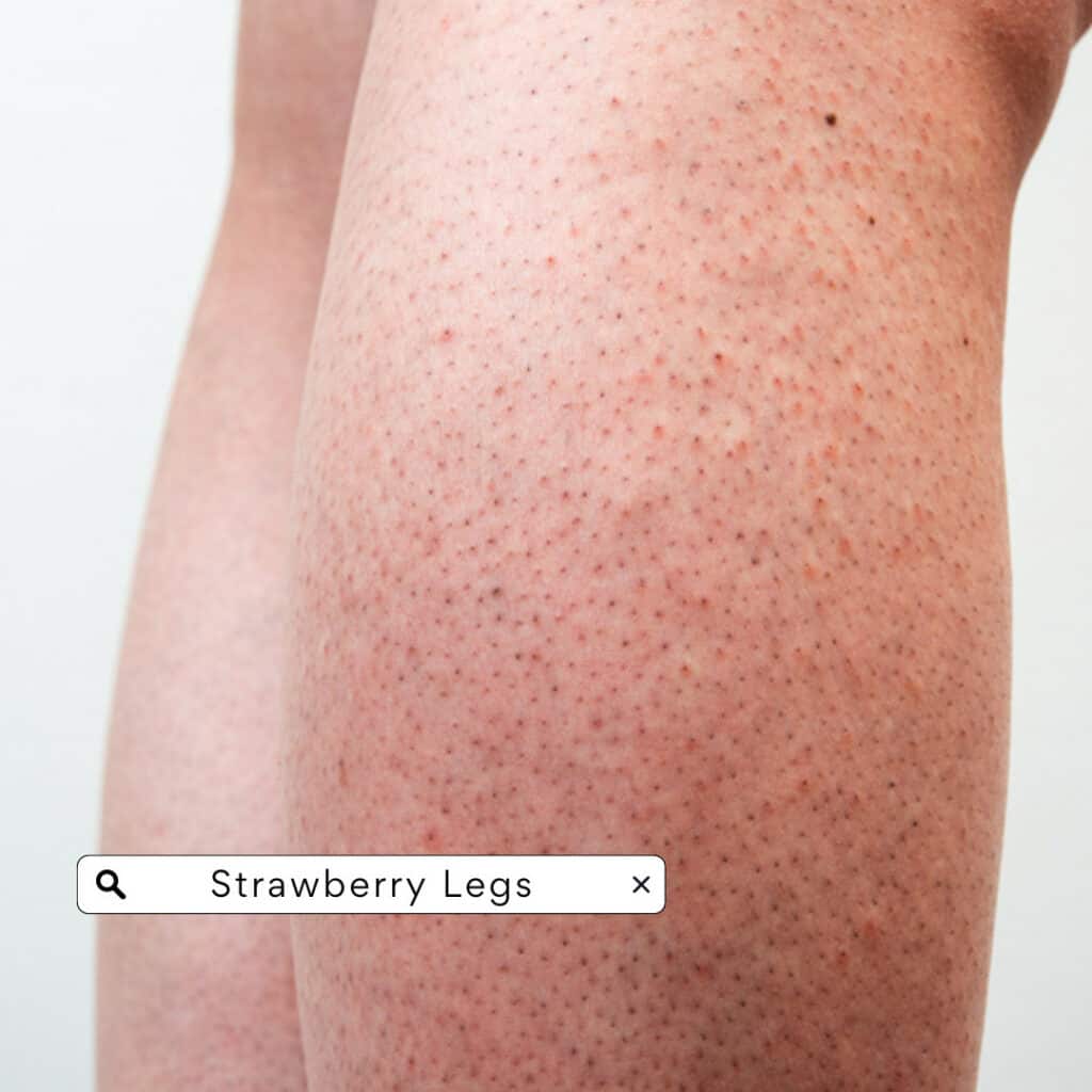 Strawberry Legs- Causes, Treatments & Prevention