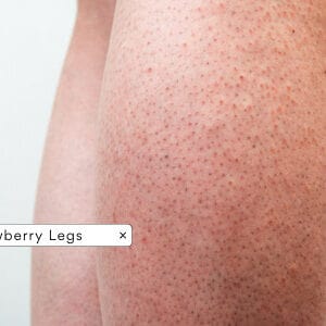 Strawberry Legs- Causes, Treatments & Prevention